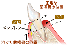 歯周組織誘導法（GTR）
