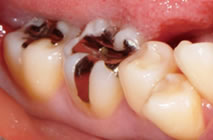 （左）保険のメタルインレー