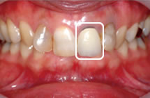 （左）メタルボンドセラミッククラウン
