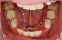 取り外しが可能な拡大装置（拡大床）