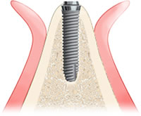 ３．インプラントの埋入