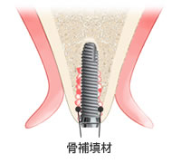 インプラントの埋入