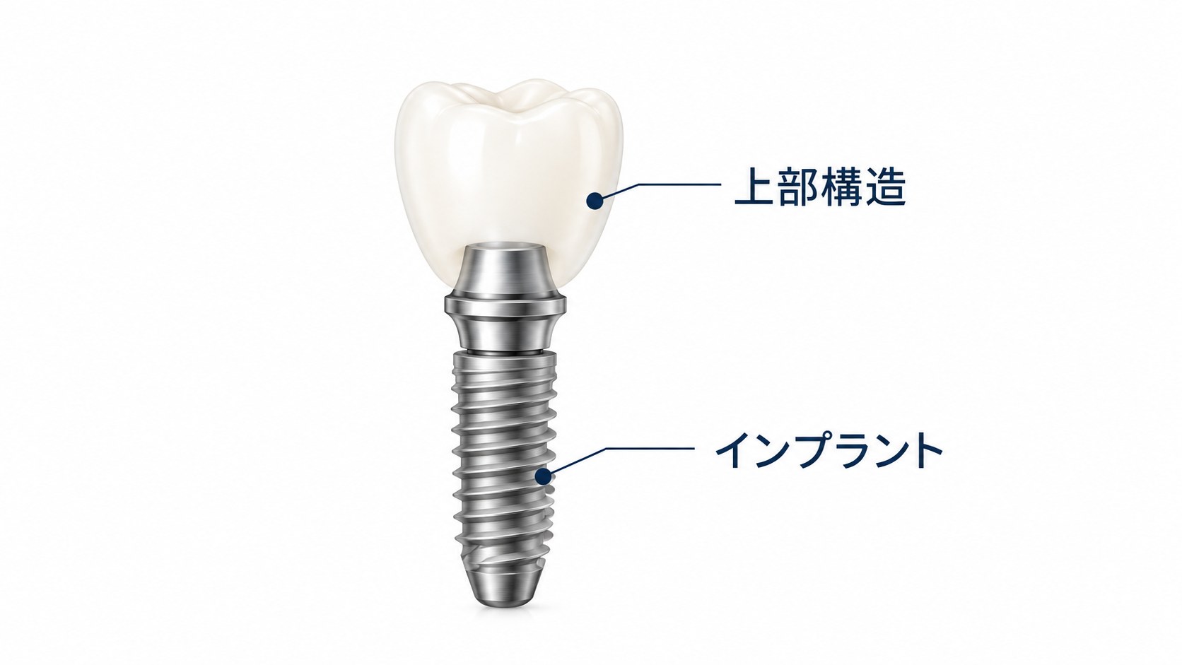 インプラントの構造（上部構造・インプラント）