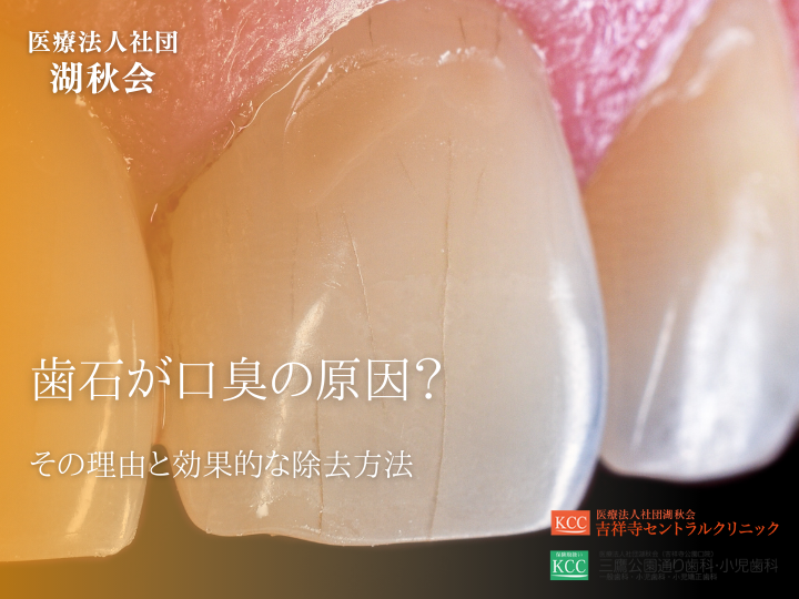 歯石が口臭の原因？その理由と効果的な除去方法